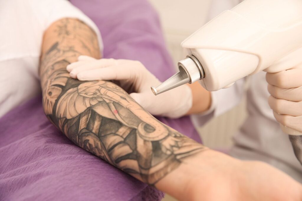 tattoo removal